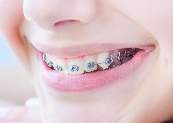 戴了牙套可以用電動牙刷嗎？戴牙套的人群必看！