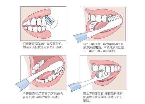 圓頭聲波電動牙刷刷牙方法 圓頭聲波電動牙刷刷牙方法之巴氏刷牙法