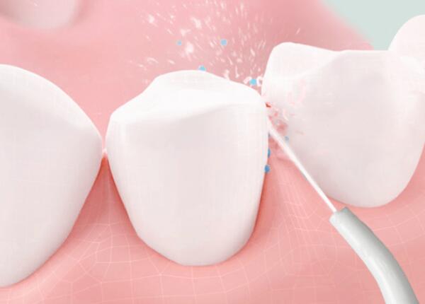 洗牙后用洗牙器好還是電動牙刷？口腔清潔工具這樣選！